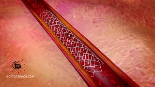 heart animation coronary arteries treatment medical animation product