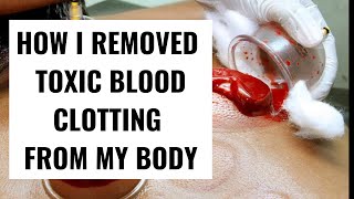 WET CUPPING REVIEW! HOW TO REMOVE TOXIC BLOOD CLOTS FROM YOUR BODY!