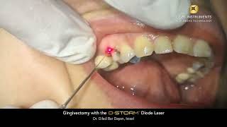 Gingivectomy with the D-Storm™ Diode Laser