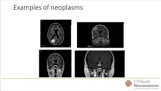 Brain Tumors and Pituitary Tumors