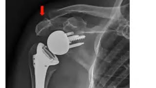 Scapular Fractures after Reverse Shoulder Arthroplasty