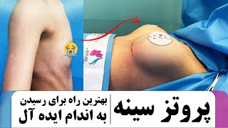 پروتز سینه_Breast prosthesis