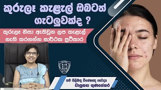 How to treat Acne (Pimple) Scars (කුරුලෑ ලප කැළැල් ඉවත් කරගමු) - Dr. Chalukya Gunasekara #skincare