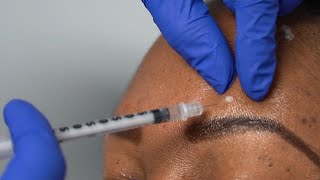 Botox Procedure At A Local Med Spa In San Antonio Texas.