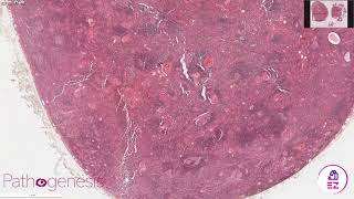 Sebaceous Lymphadenoma