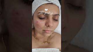 The feeling of #acnetreatment laser treatment. #ytshorts #skincare