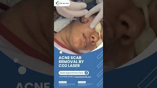 Co2 Laser treatment #shorts #acne #treatment #dermatology  check channel playlist for such videos