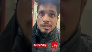 Idiopathic Bell’s Palsy 🧠 #viral #shortsyoutube #neurology #shorts لقوہ