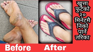 Cracked heels Treatment in 20 minutes || Cracked heels Home Remedy || Padicure at home|Cracked heels