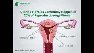 HEALTH TALK SHOW  TOPIC: WHAT YOU DONT KNOW ABOUT UTERINE FIBROIDS