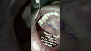 Oroantral fistula repair using anteriorly pedicled tongue flap, part 5  #mentoring #speech #viral