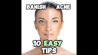 How to Easily Get Rid of Acne: 10 Simple Tips #acne #skincare #health