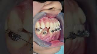 Avoid extracting trapped teeth