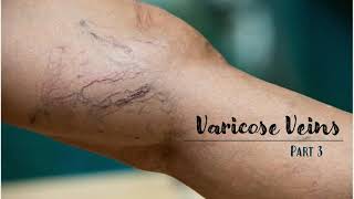 White cell hypothesis| Fibrin cuff Hypothesis| Varicose Veins Part 3