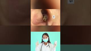 Dr.Nattacha, blackheads ears.