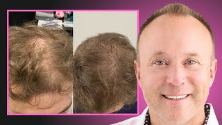 PRP Hair Restoration Journey