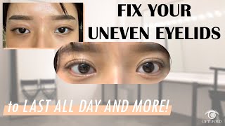 Treatable Cases 6 | Making double eyelids or fixing uneven eyelids with Optifold