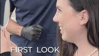 First look after natural rhinoplasty | Dr. med. Simon Zimmermann