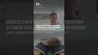 Trockener Mund bei Menschen mit Down Syndrom  #downsyndrom #handicap #tagderzahngesundheit