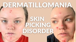 Dermatillomania (skin picking) - My Story & Tips