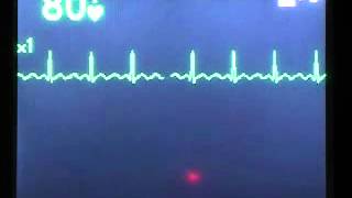 Atrial Flutter.wmv