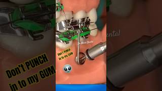 Don’t PUNCH IN ! Braces Mechanics