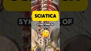 You probably don’t have SCIATICA 🤷‍♂️