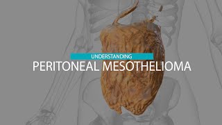 Peritoneal Mesothelioma | Mesothelioma Hope