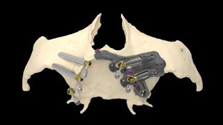 EZgoma Technique: Zygomatic Guided Procedure