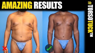 360 Torso Tuck Body Lift with BodyBanking for Men with Dr. Steinbrech