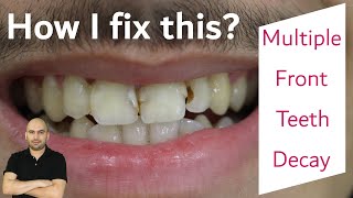 Front Teeth Refilling | How Dentist Remove Tooth Decay? | Front tooth caries repair.