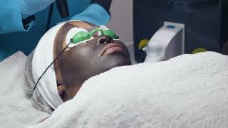 Wonder laser facial/Carbon Peel @coollookbeauty