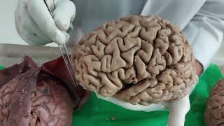 Dissection: Cerebrum