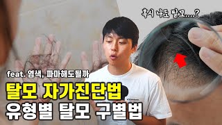 나는 어떤 유형의 탈모일까? 초간단 탈모 자가진단법!!  (feat. 탈모인도 염색, 펌 가능?)