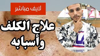 لايف مباشر علاج كلف و علاج تصبغات الوجه و إجابة على أسئلتكم