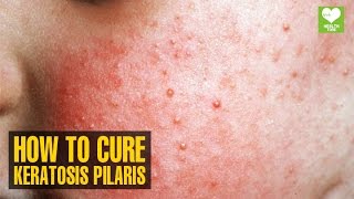 Keratosis Pilaris - Home Remedies | Health Tips | Educational Video