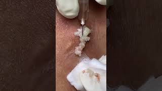 Big Cystic Acne Blackheads Extraction Blackheads & Milia, Whiteheads Removal Pimple Popping #shorts