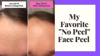 My Favorite No Peel Face Peel