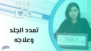 تمدد الجلد وعلاجه