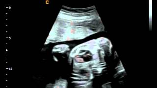 Q5 by Chison  imaging Fetal Heart sonogram , easy to see heart in fetus, neonatal ultrasound