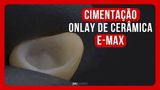 CIMENTANDO ONLAY DE CERÂMICA E-MAX