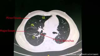 CT anatomy of Right Lung