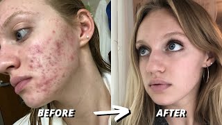 HOW I CLEARED 7 YEARS OF SEVERE ACNE | ACCUTANE JOURNEY