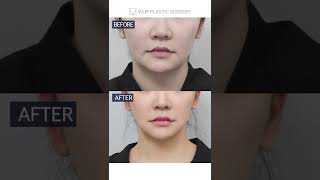 [B&A] Mini Facelift, Platysmaplasty In Korea Plastic Surgery #shorts