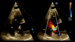 Coronary Sinus Stenosis