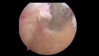 Greater Tuberosity Avulsion Fracture | Arthroscopic Treatment | Colorado Shoulder Surgeon