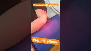 درمان سندرم آرنج تنیس بازان یا #tenniselbow با تمرین،ماساژ و سوزن |کلینیک توانبخشان #video #viral