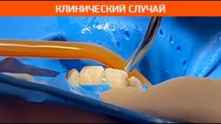 Фтор Люкс для глубокого фторирования