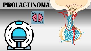 Prolactinoma - Causes, Risk Factors, Signs & Symptoms, Diagnosis, And Treatment