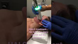 #halotreatmentdemo #Skin #resurfacingtreatment #halodemo #esthetician #laserresurfacing #halo #short